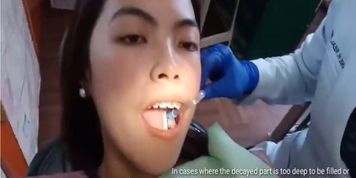 beauty with braces gets cavity filling