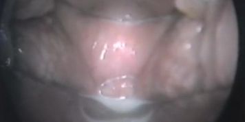 [medicine] Orgasm Vagina voascope