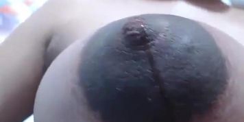 Huge areolas