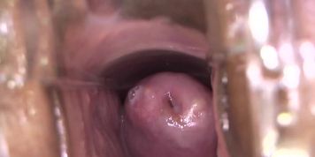 Laughing Cervix