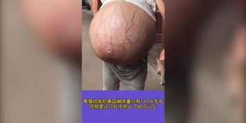 Chinese Woman has uncontrollably growing belly