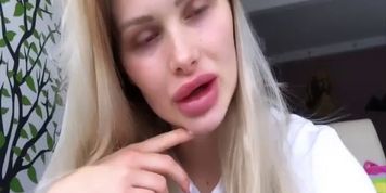 Too much surgery fake lips