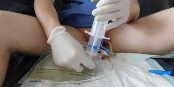bladder lavage, 3-way catheter