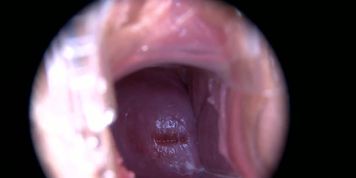 Keyhole