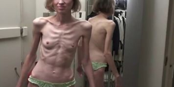 Anorexic  MILF Sonja