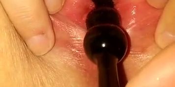 Anal bead peehole