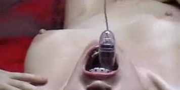 braces tease