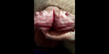 subincision cock split