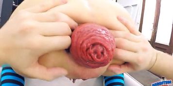 Most Extreme Anal Prolapse and Cervix Prolapse So Far. Fist.