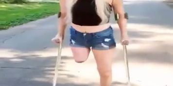 amputee girl