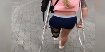 Arm Amputee Girl Crutching Around